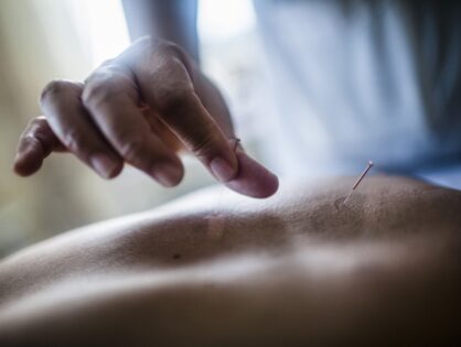 Akupunktura - zabieg nakłuwania odpowiednich punktów na ciele. Jak wygląda samopoczucie po akupunkturze?