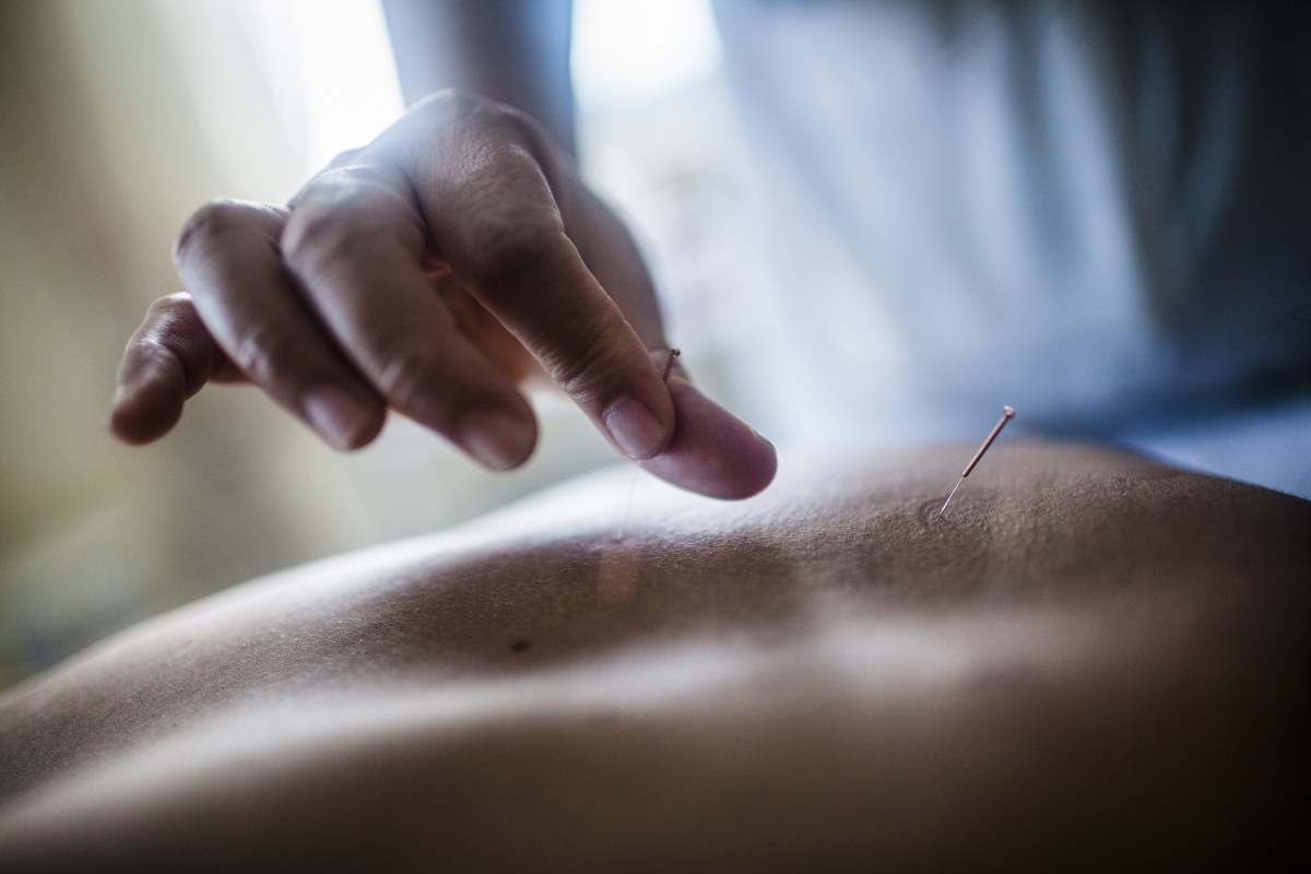suche igłowanie medyczna akupunktura